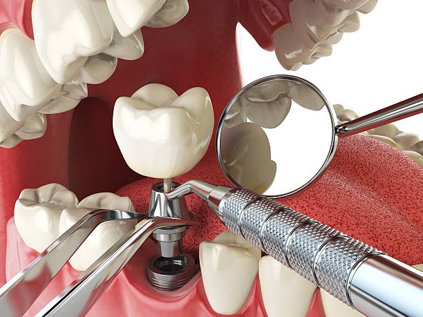 Best Emergency Treatment for Dental Infections or Abscesses in Wilkinson Heights, SC